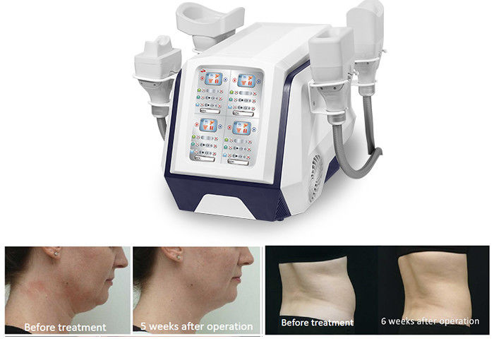 De draagbare 360 Cryolipolysis Machine 1000W van het Lichaamsvermageringsdieet voor Vet het Branden Gewichtsverlies